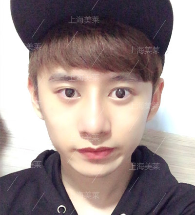 李?？?上海美萊醫(yī)院自體軟骨隆鼻