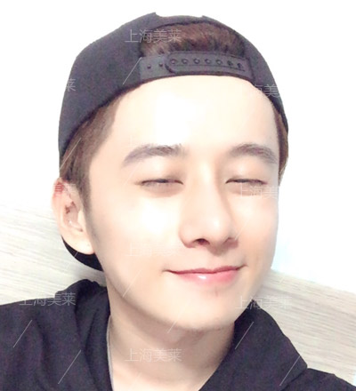 李?？?上海美萊自體軟骨隆鼻手術(shù)