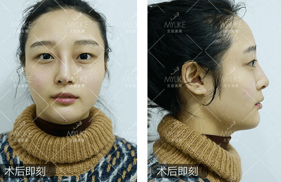 玻尿酸注射、+北京美萊無創(chuàng)案例