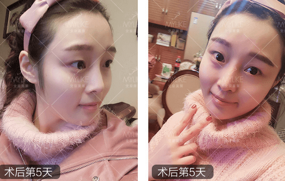 玻尿酸注射、+北京美萊無創(chuàng)案例