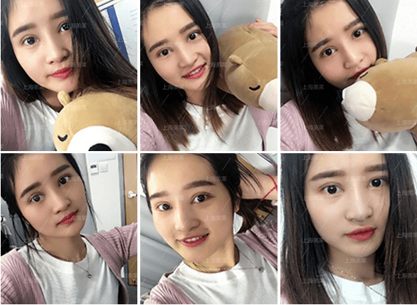 米婭大眼術(shù)、