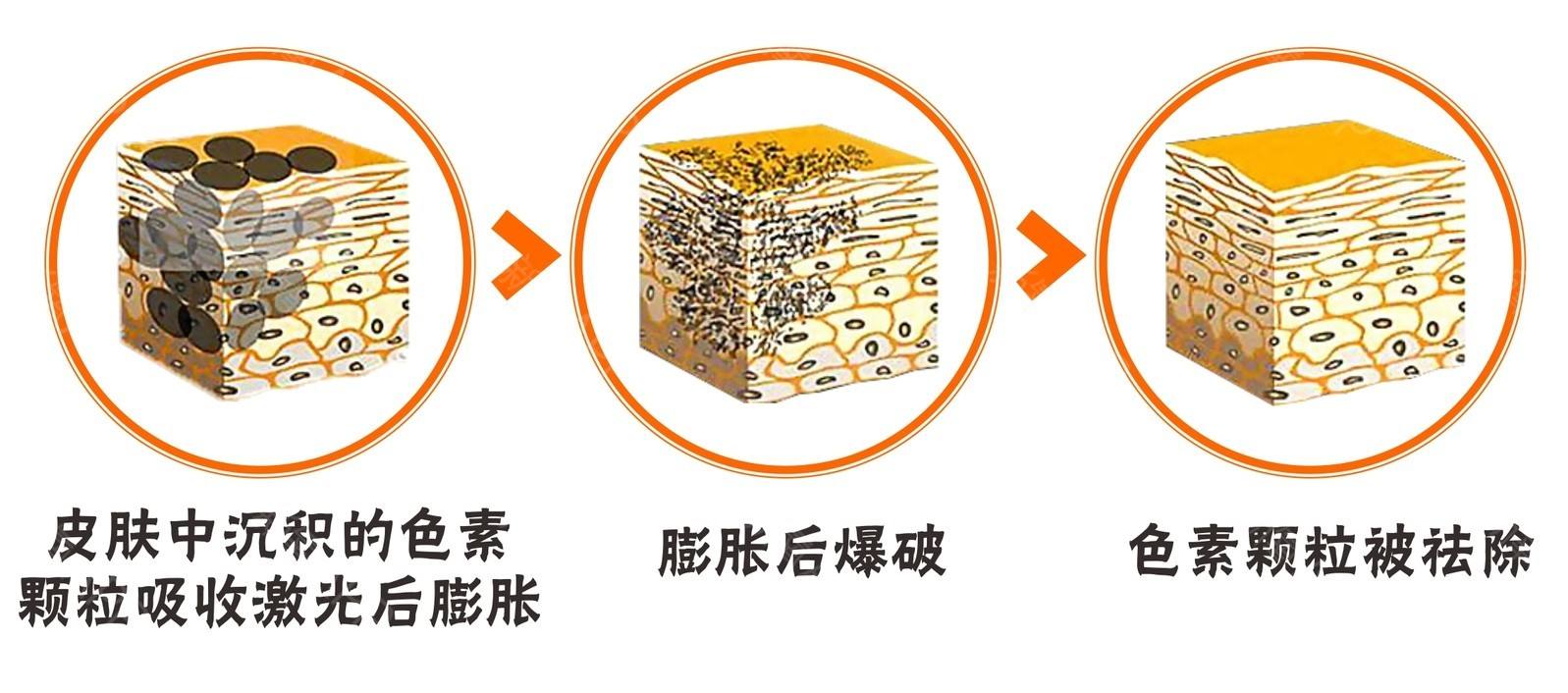 激光祛斑手術(shù)會有留疤的風險嗎