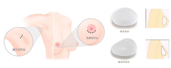 假體隆胸的效果可以保持多少年