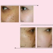 麗江日曬斑怎么祛除價(jià)格多少