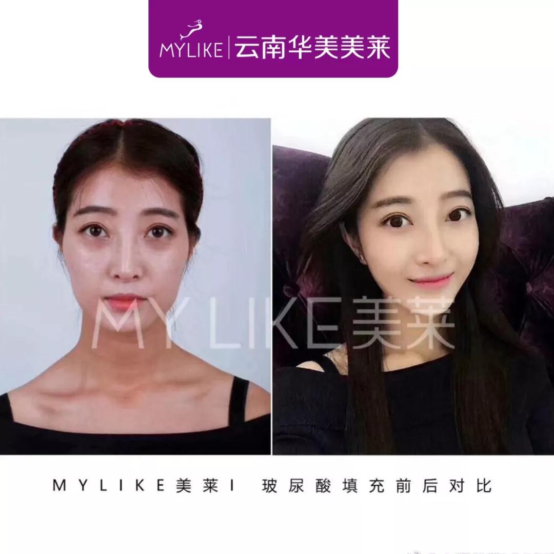 昆明打玻尿酸哪家好，打玻尿酸副作用有哪些？