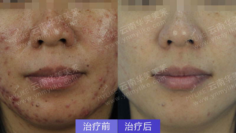 為什么額頭會(huì)長(zhǎng)痘，怎么祛除？