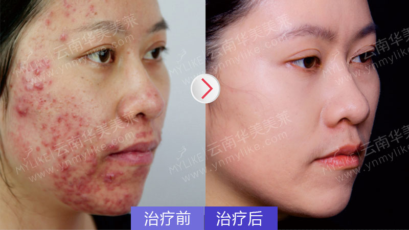 為什么額頭會(huì)長(zhǎng)痘，怎么祛除？