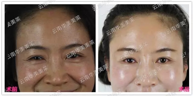 大中小分子玻尿酸有什么區(qū)別，法令紋又是用的什么