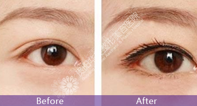 紋眉術(shù)后多久才能恢復呢