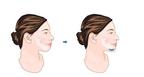 假體整形下巴多少錢呢