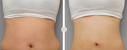 <a href='/tj/' target='_blank'><u>天津美萊</u></a>躺著也能瘦的小妙招