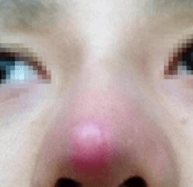 武漢打玻尿酸隆鼻會(huì)不會(huì)留下后遺癥？