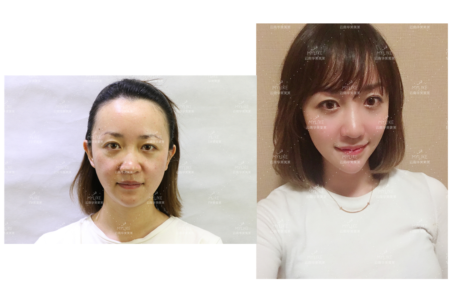 出演電視劇《官渡人家》的小姐姐必做的醫(yī)美項(xiàng)目！！美萊雙十一get好物推薦