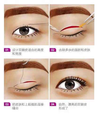 昆明影響割雙眼皮的因素有哪些，多少錢