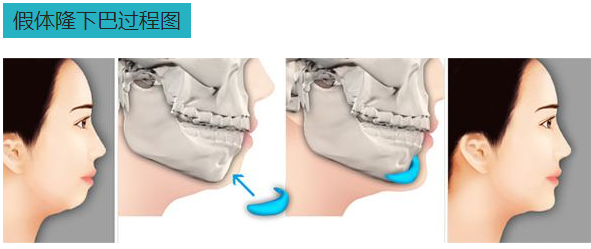做假體墊下巴前有哪些準(zhǔn)備事項