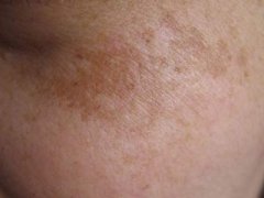 廈門做激光祛黃褐斑會(huì)有特別痛的那種感覺(jué)嗎