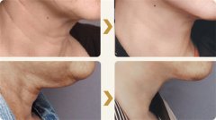 南京做射頻除皺有什么注意事項