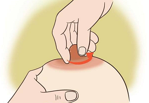 蘇州乳頭內(nèi)陷矯正手術(shù)的價格貴嗎