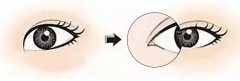 成都做開(kāi)眼角手術(shù)一般有哪些整形方法