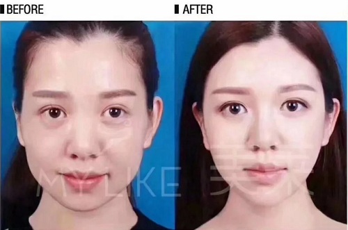 瘦臉針打三次就能真的定型嗎？？？