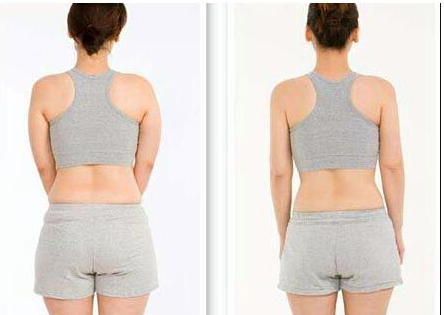 福州吸脂減肥可以同時做幾個部位?