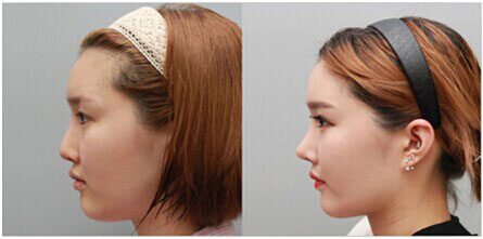 佛山注射隆鼻的恢復(fù)時(shí)間多久?