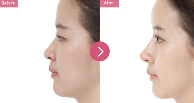 西安假體隆鼻是不是很疼？