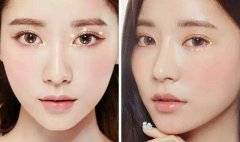 深圳現(xiàn)在流行哪種割雙眼皮方式？