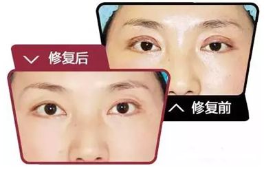 佛山什么時(shí)候做雙眼皮修復(fù)手術(shù)效果會(huì)比較好呢