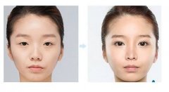 深圳上眼瞼下垂怎么治療？