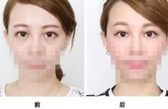 通過手術(shù)祛眼袋多久看都效果?會(huì)有疤痕嗎？
