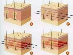 提升術(shù)能維持多久？