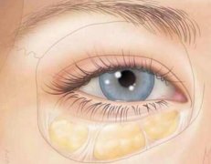 杭州祛眼袋要花多少錢？