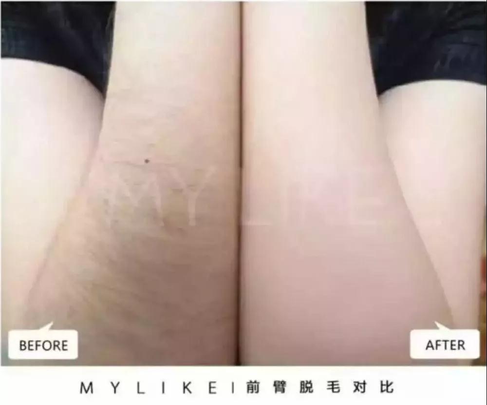 激光手臂脫毛術(shù)后會留下疤痕嗎