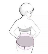 重慶做臀部吸脂減肥有哪些要注意的方面？