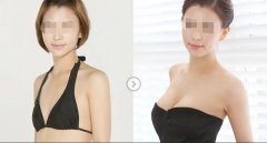 武漢自體脂肪隆胸的效果好不好？