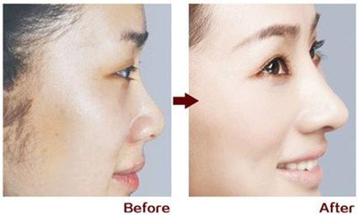 廣州隆鼻價(jià)格是多少？貴不貴？