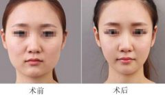 重慶面部吸脂能快速瘦臉嗎？