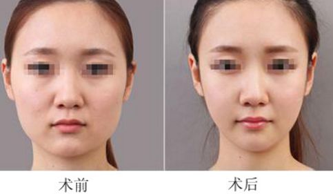 重慶面部吸脂能快速瘦臉嗎？