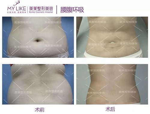 美萊醫(yī)院：據(jù)說男人都愛這種“沙漏身材”？！