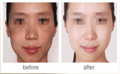 廣州光子嫩膚祛斑要多少錢？