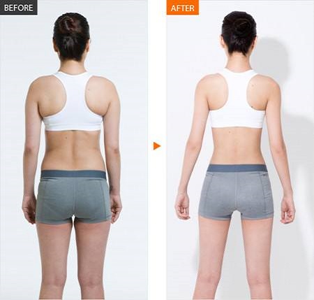 背部吸脂手術(shù)多少錢?