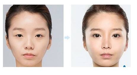 天津做上瞼下垂矯正的價(jià)格是多少？