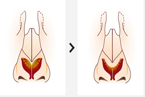 自體軟骨組織隆鼻有哪些優(yōu)點(diǎn)？