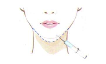 天津瘦臉有效果要注射幾次？