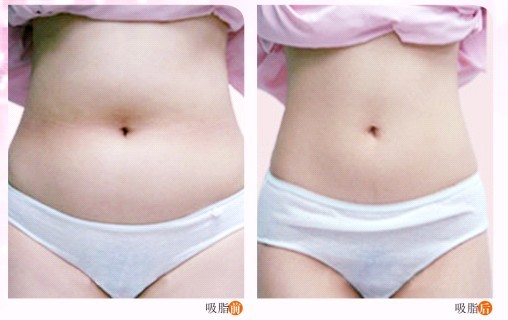 武漢適合做吸脂減肥手術(shù)的年齡段是多少？