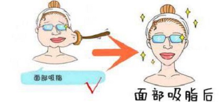 做面部吸脂手術(shù)費用高嗎