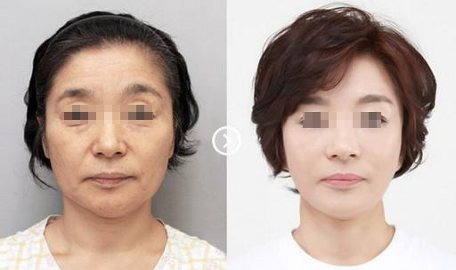 深圳激光除皺價(jià)格多少錢？能?徹底的去除嗎?