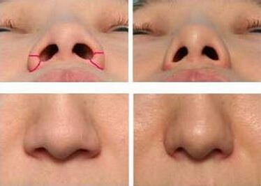 鼻孔大怎么辦？能做手術(shù)縮小嗎？