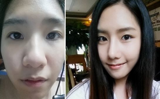 鼻頭縮小手術(shù)恢復(fù)時間要多長呢？